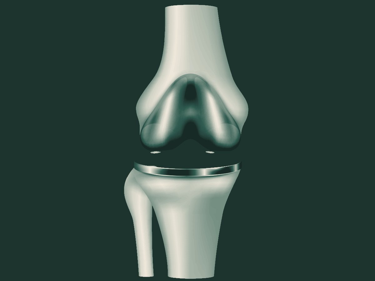 Total knee implant — prosthetic femoral and tibial components